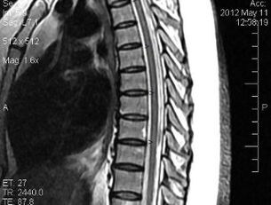 RMN a coloanei vertebrale toracice