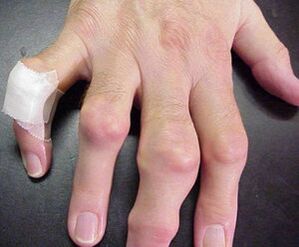 degetele cu deformări articulare provoacă durere