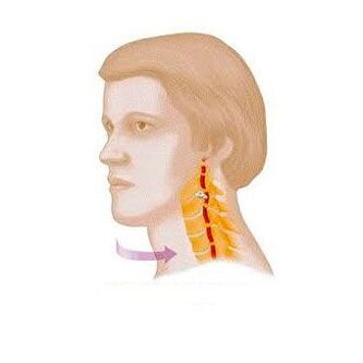 sindrom vertebral cu osteocondroză cervicală