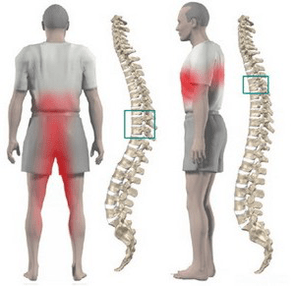 dureri de spate în osteocondroza toracică