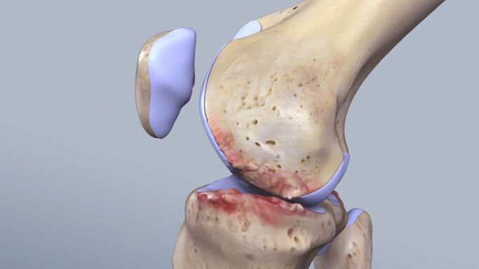 Structura articulației genunchiului afectată de patologie