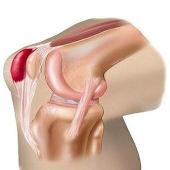 Una dintre cauzele durerii la nivelul articulației genunchiului este bursita. 