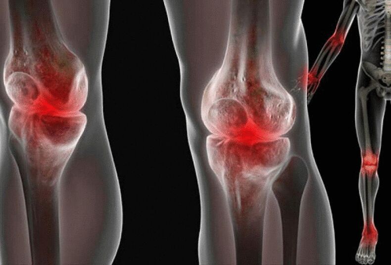 Dureri la nivelul articulațiilor brațelor și picioarelor cauzate de diferite boli