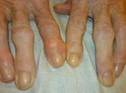 Osteoartrita articulațiilor mici ale mâinilor