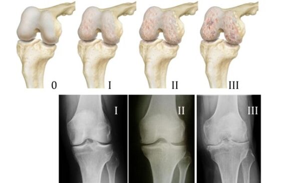 metode de diagnosticare a artrozei genunchiului